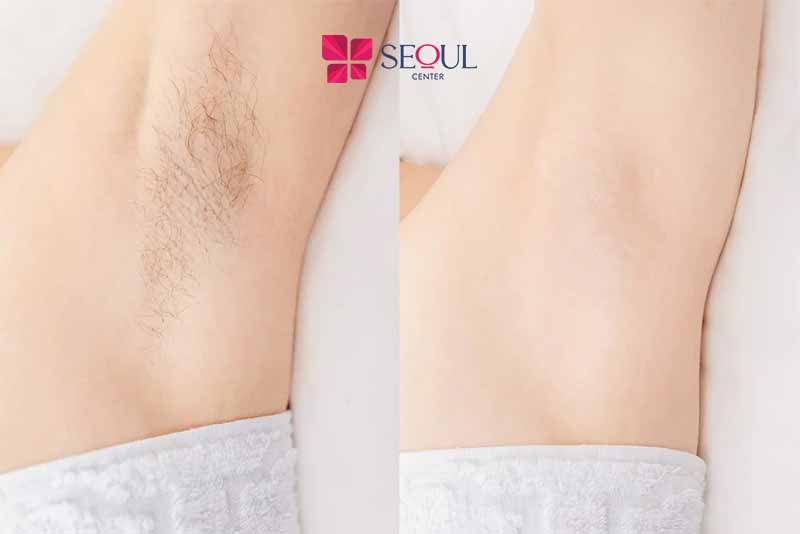 Nano Laser - Công nghệ triệt lông tân tiến tại Seoul Center